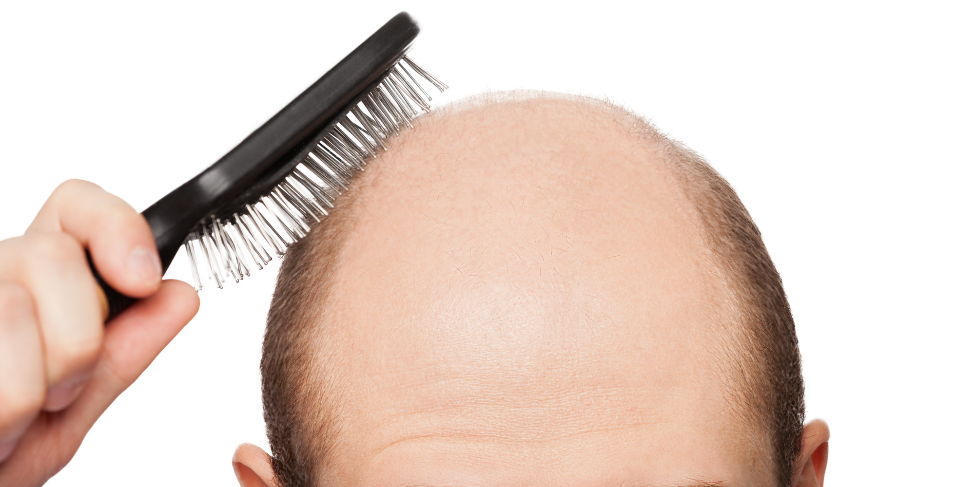 Is your hair loss leading to baldness? | Kalnirnay Blog