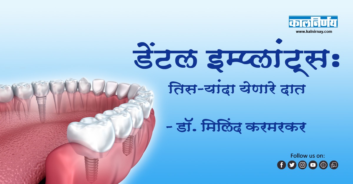 इम्प्लांट | Dental Implants | Dr. Milind Karmarkar | Implant