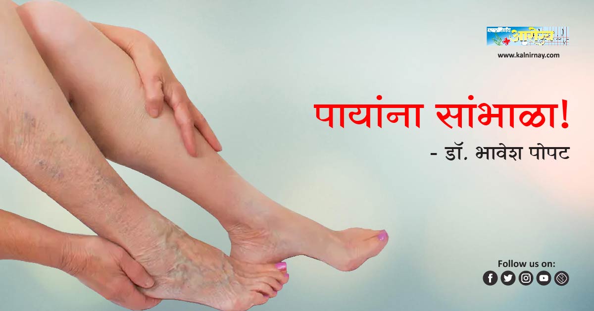 व्हेन्स | black veins on legs | veins | swollen veins | veins in feet | spider veins on legs | varicose veins in foot | deep leg veins