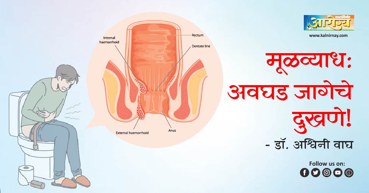 मूळव्याध | Piles | haemorrhoid symptoms | piles stool | hemorrhoids treatments | causes of piles in female | hemorrhoids during pregnancy | piles disease